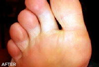 foot after treatment