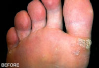 foot with verrucae