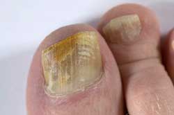 Fungal Nail infection