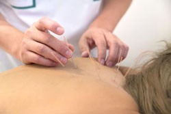 Medical Acupuncture