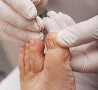 toenail surgery